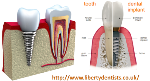 Tooth Dental Implant